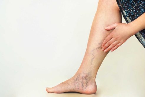 How You Can Prepare Your body For Spider Vein Removal