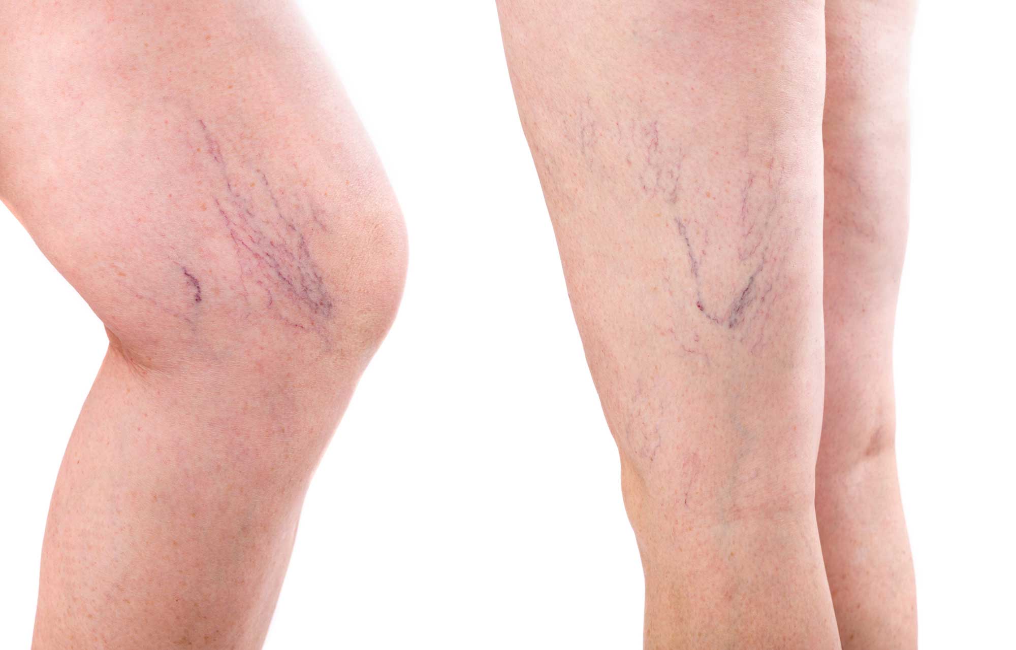 The Difference Between Varicose And Spider Veins - The Vein Institute